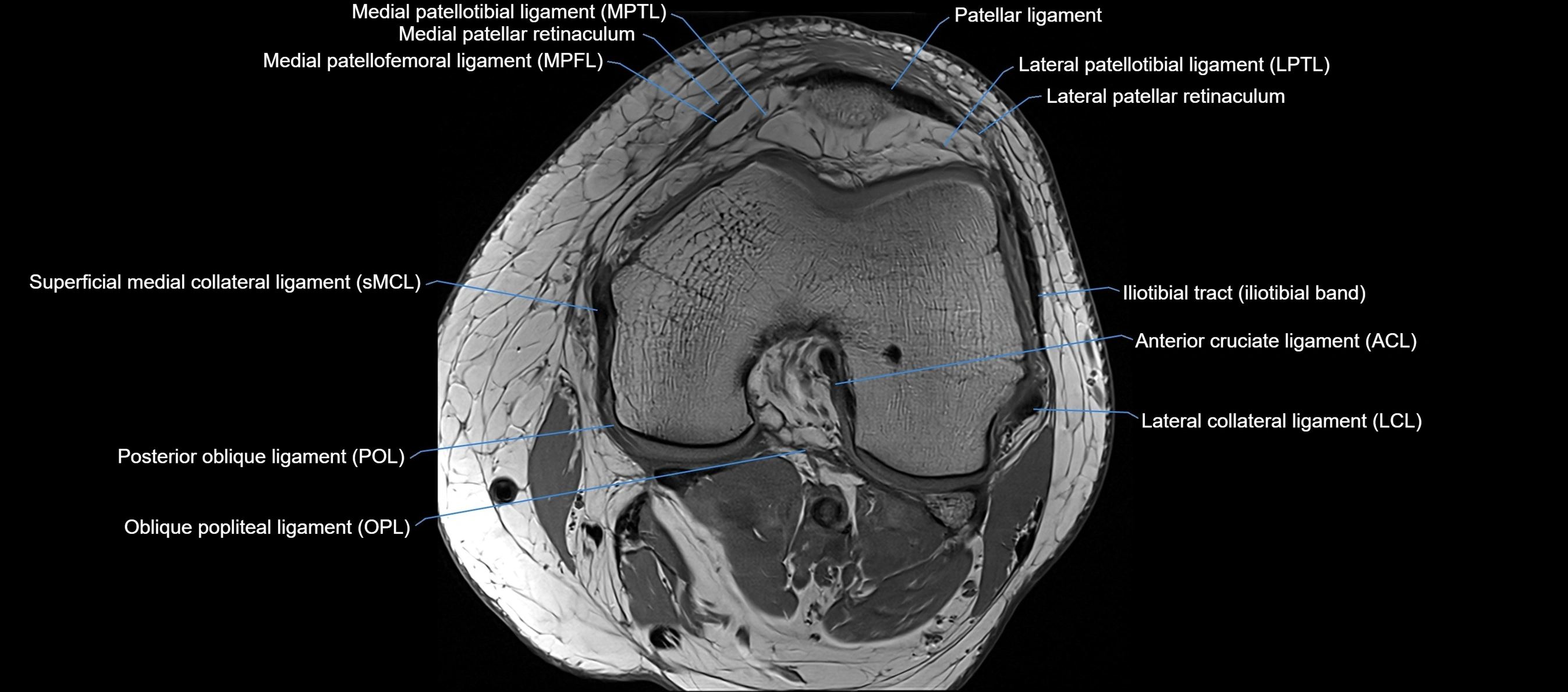 MRI Knee axial  ligaments cross sectional anatomy 3T  radiology  image-img-03001-00022.webp